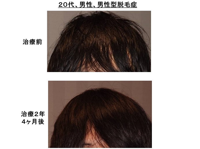 円形脱毛症　病院""